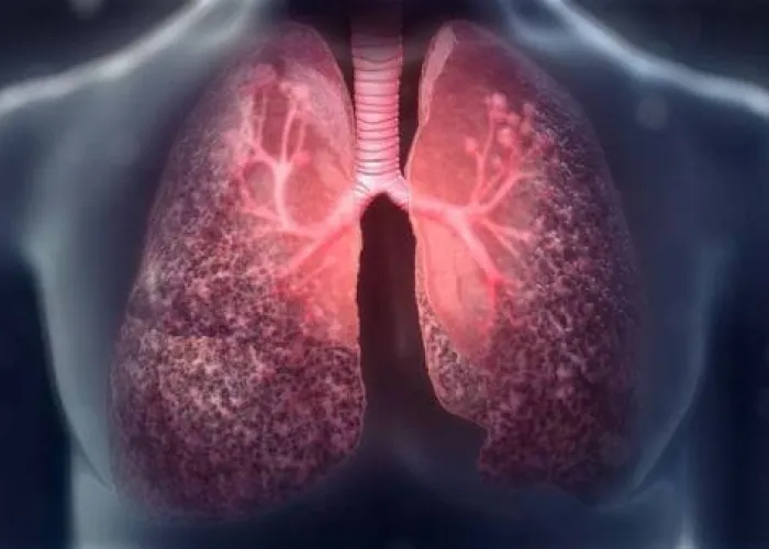 Foto Pacienții cu mutații rare de fibroză chistică capătă acces la terapie modernă