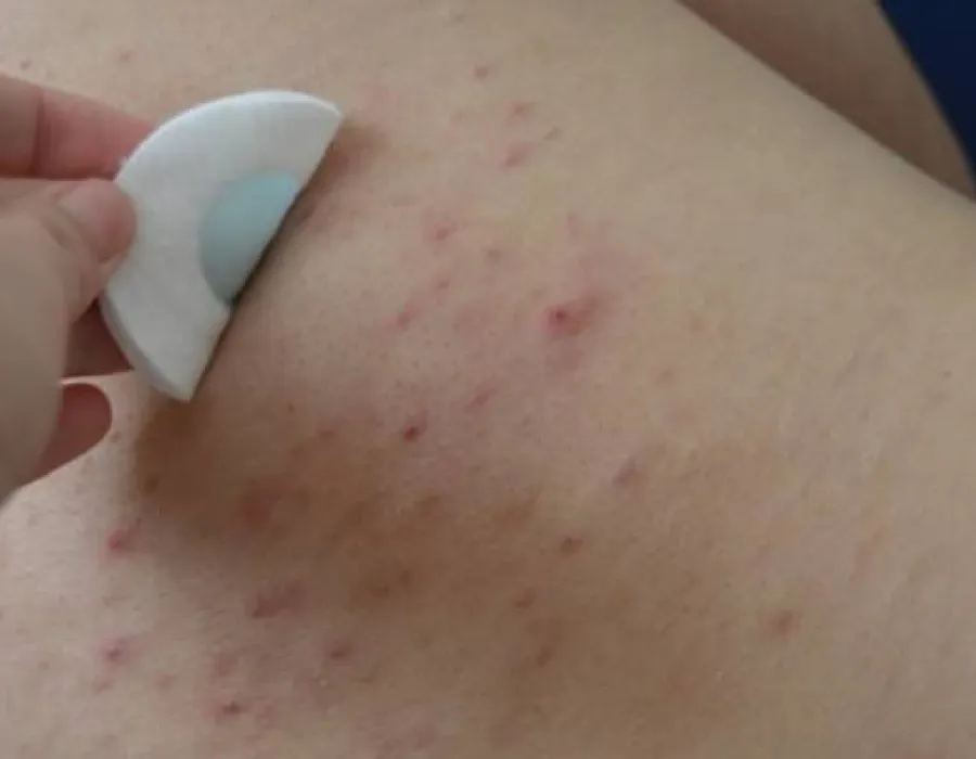 Foto Cum scapi de coșurile de pe spate. Cele mai simple metode naturiste
