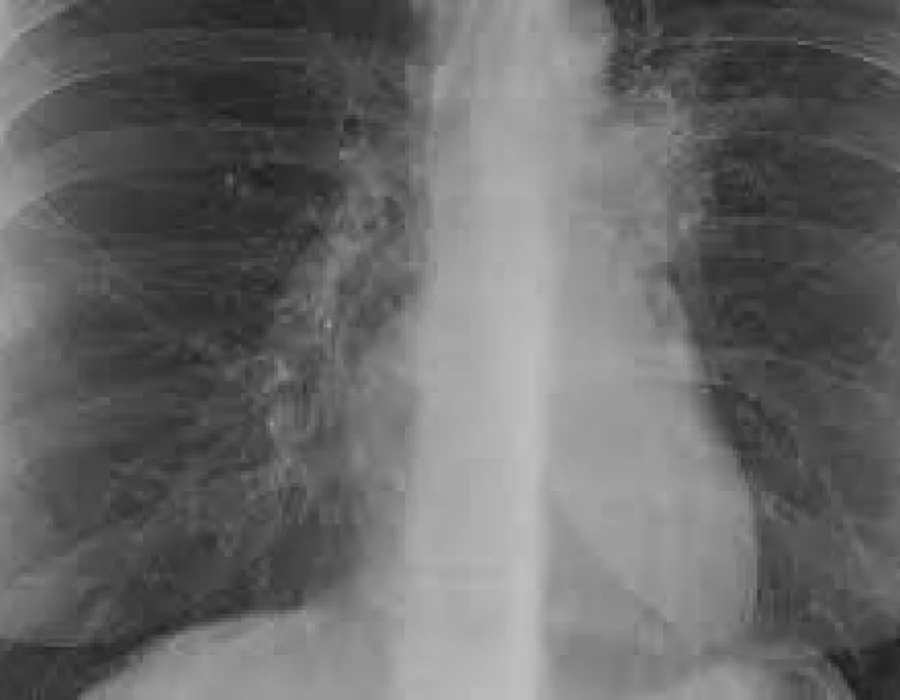 Foto 14.000 de cazuri de tuberculoză (audio)