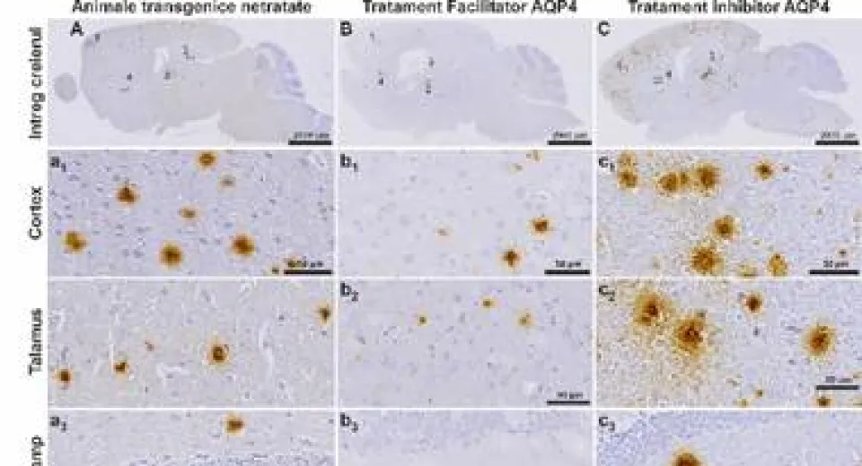Foto Descoperire importantă la UMF Craiova: O proteină-cheie ar putea deschide noi tratamente pentru Alzheimer